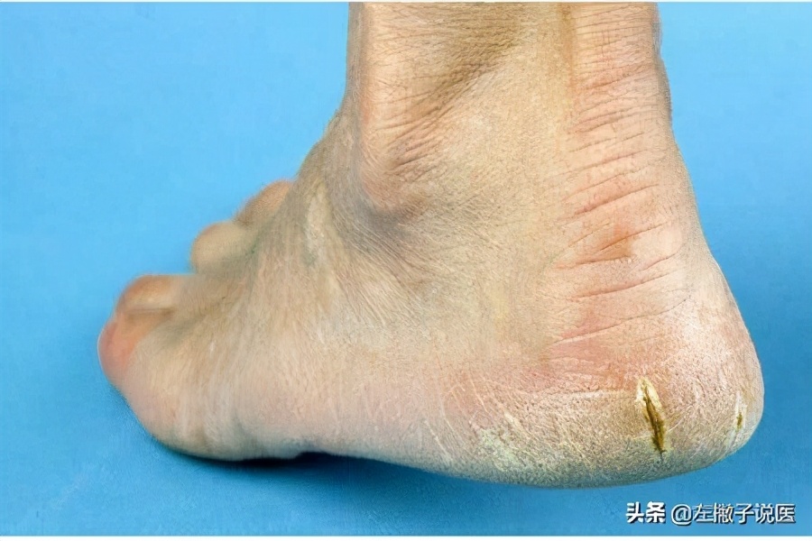冬天脚后跟开裂起硬皮怎么办,一到冬天脚后跟裂口怎么回事