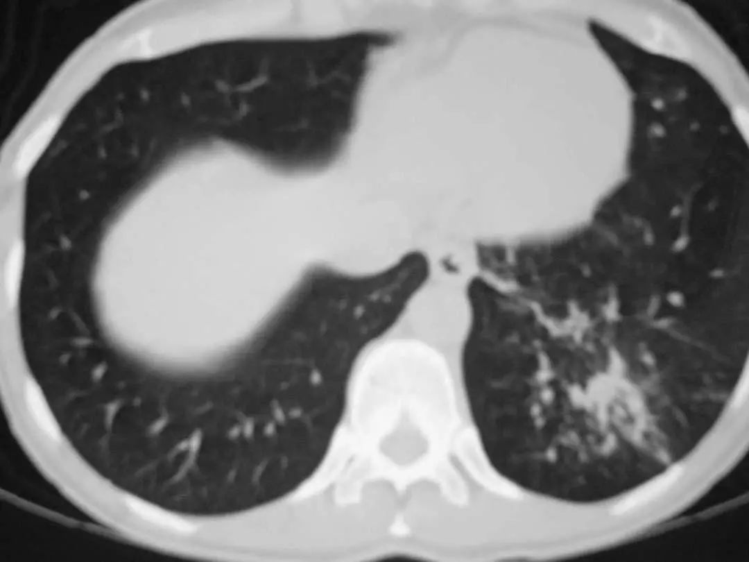 肺炎炎症图片,肺炎病历单图片