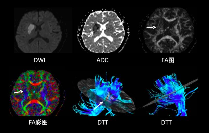 磁共振成像mri的基本原理,磁共振后dti怎么处理