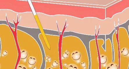 一样都是皱纹，打针和手术到底怎么选？|北京大学张宗学