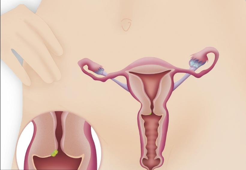 女性宫颈糜烂会影响怀孕吗,宫颈糜烂息肉不孕不育