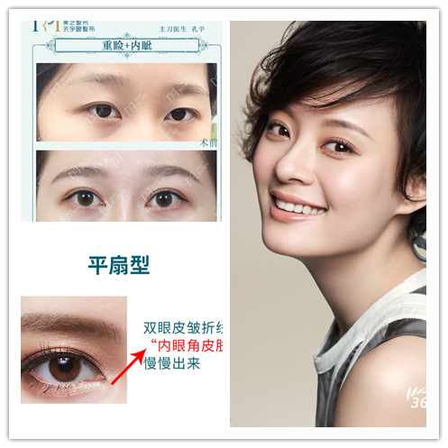 做双眼皮时判断出肌无力但未提肌,做双眼皮说是眼睛肌力不够