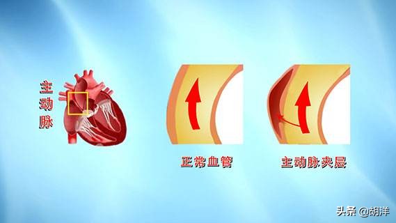 主动脉夹层破裂死亡的根本死因,主动脉夹层破裂死亡率