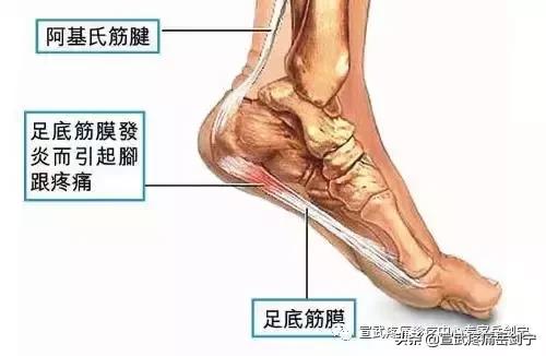 脚后跟尿酸堆积痛怎么缓解,缓解脚后跟痛踩台阶视频