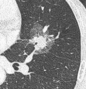 肺结节无任何症状中医治疗肺结节,体检查出肺结节莫慌中医有妙招