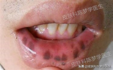 褐青色雀斑多久能治好,脸上起褐斑怎么治效果快