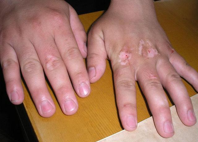 外用药也可以治白癜风吗？赶紧看看