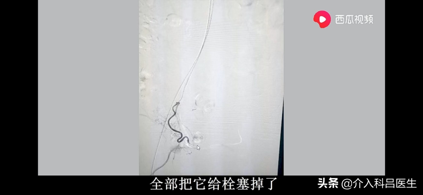 不死的癌症肠易激综合征,不死的癌症中医治疗