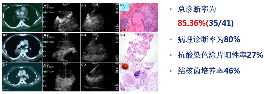 小细胞肺癌的气管镜介入治疗,导航支气管镜在肺癌诊断中的应用