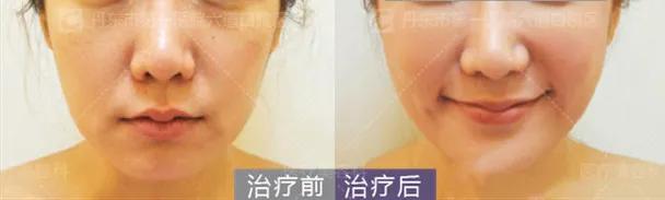 拥有一张好看的脸,如何拥有好看的脸型