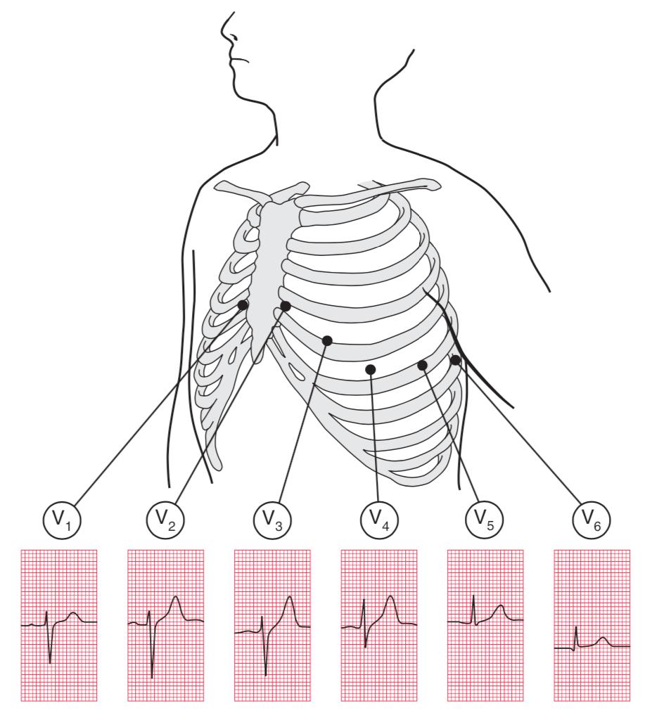 心电图的st向量怎么看,心电图中的sv1代表什么