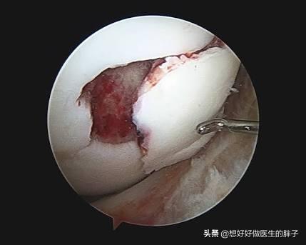 骨刺吃什么药可以抑制骨刺的生长,长骨刺独家药方喝四天就能止痛