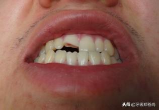 小孩牙齿磕了后牙齿发黑怎么办,牙齿被磕掉一半后牙齿变黑了