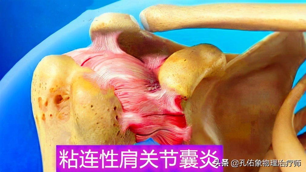 什么原因引起肩周炎手臂活动受限,引起肩周炎疼痛是什么原因