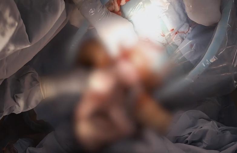 腹中胎儿长出肿瘤，孕妇忍着剧痛，给胎儿打麻药做手术