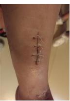 术后伤口要每天换药吗,术后伤口拆线还需要敷纱布吗