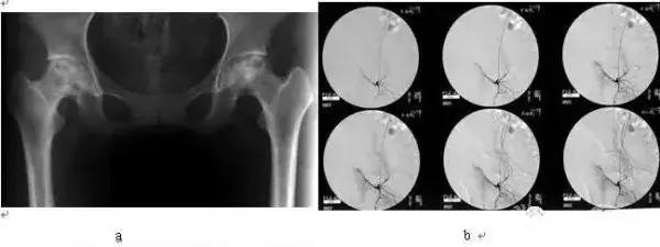 股骨头坏死早期介入和干预,股骨头坏死早期介入治疗