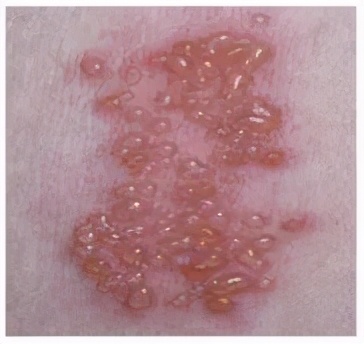 生蛇有什么急救方法吗,生蛇要注意些什么