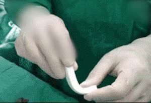 隆鼻膨体好还是玻尿酸好,硅胶膨体和玻尿酸隆鼻