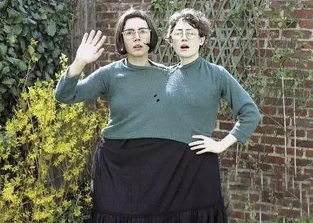 假如有一个连体人去世的后果,如果连体人死了另一个怎么办