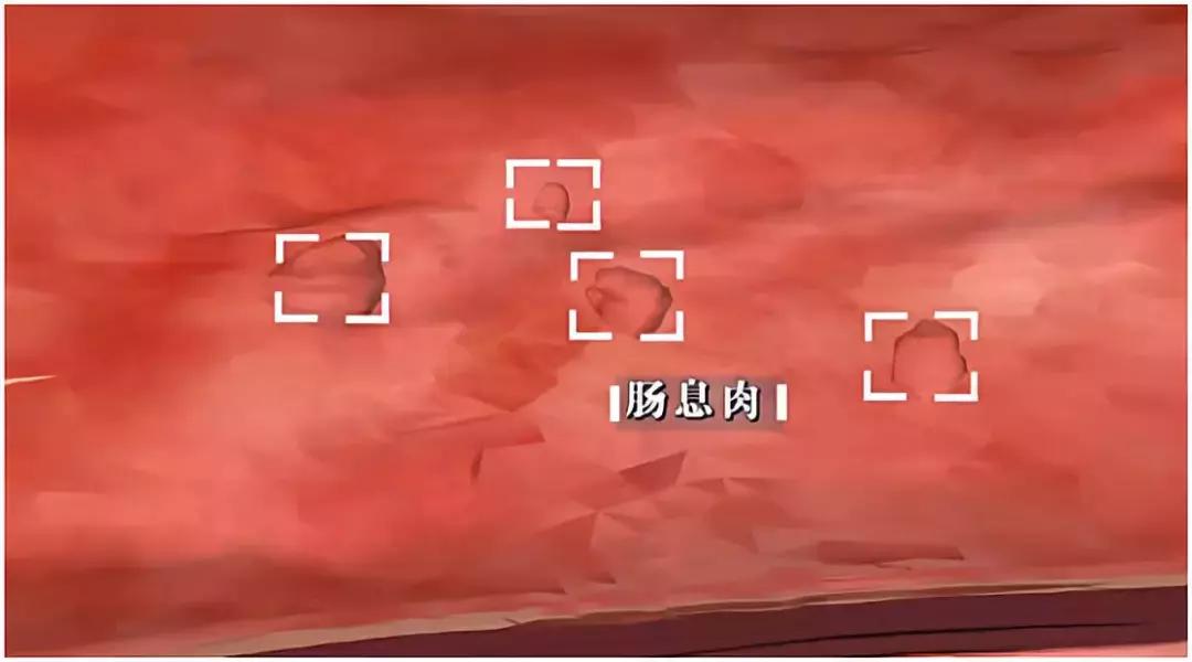 息肉切了有癌细胞是癌症吗,切了息肉还会得癌症吗