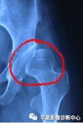 先天性髋关节脱位饮食,先天性髋关节脱位属不属于残疾人