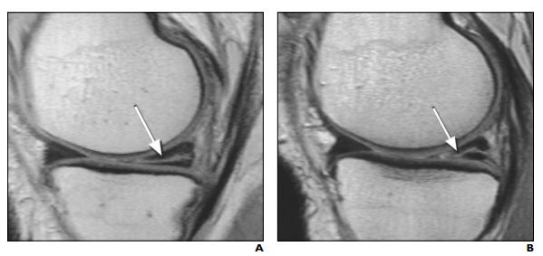 半月板损伤手术需要恢复多长时间,半月板损伤2-3级手术需要多少钱