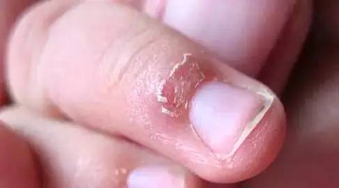 几块钱的罗红霉素管用吗,红霉素软膏多少钱有什么作用