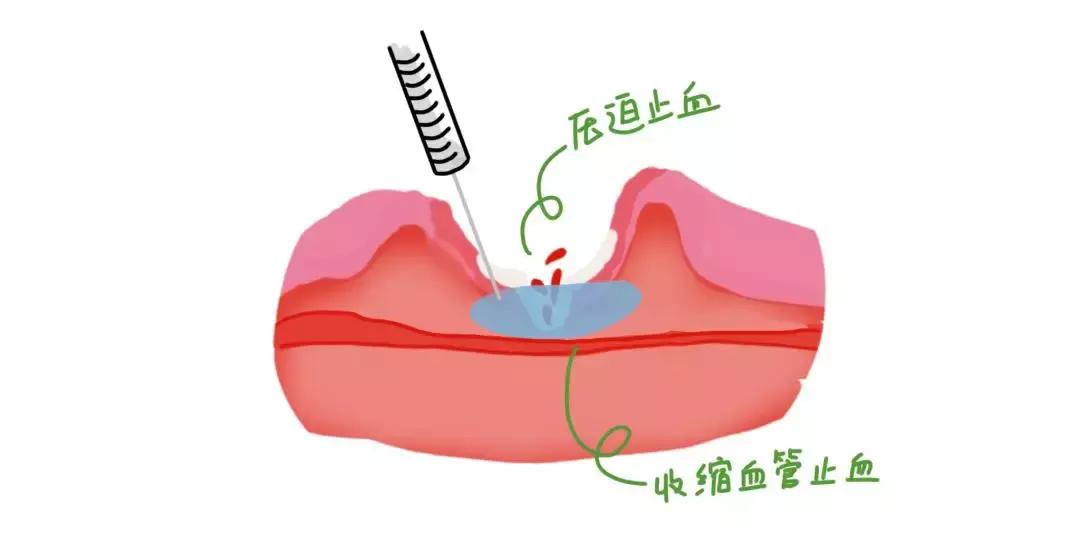 小林历险记二：胃镜大揭秘