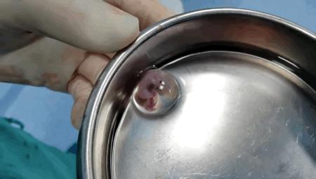 月经淋漓不尽突然大出血啥原因,月经淋漓不尽还腹痛腹胀是什么病