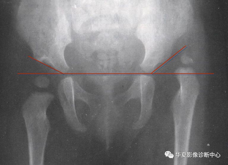 先天性髋关节脱位饮食,先天性髋关节脱位属不属于残疾人