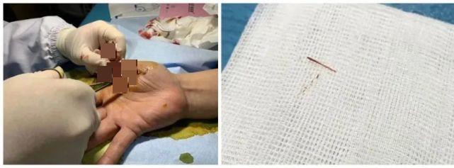 玻璃扎进手指了取不出来,玻璃扎进手指里取不出来怎么办