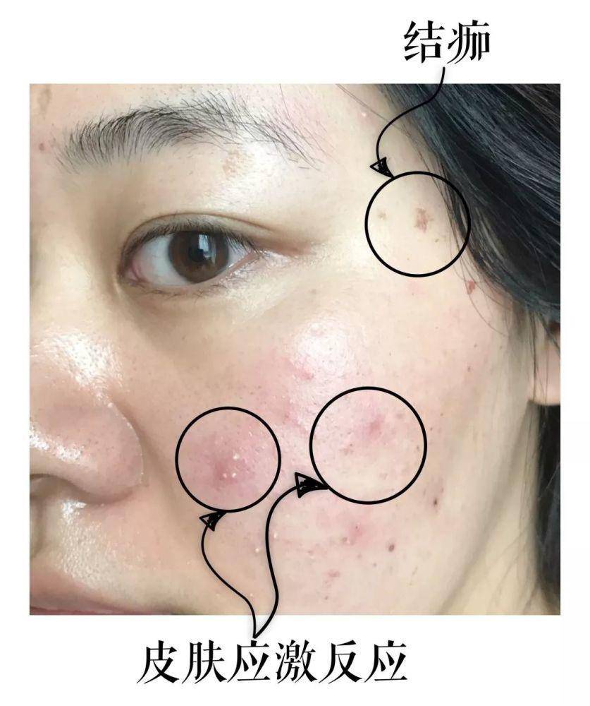 痘痘反反复复又红又疼又痒,痘痘反反复复有一层皮