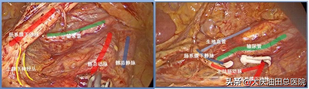 84岁老人直肠癌微创手术,直肠癌手术成功无转移