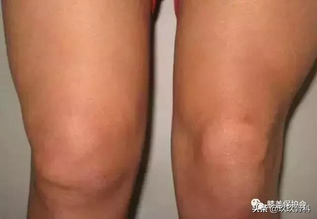 膝盖肿胀疼痛，滑膜炎找上门，要如何应对？