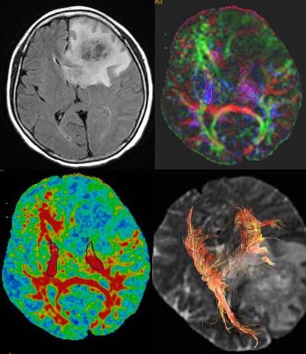 磁共振成像mri的基本原理,磁共振后dti怎么处理
