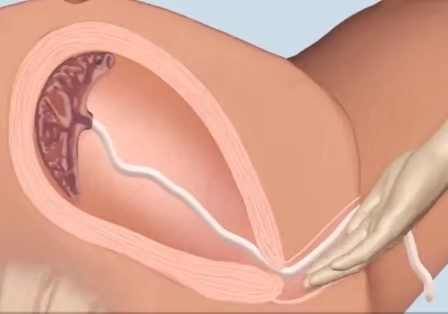 顺产从宫缩到生需要多久,顺产从开指到生一般要多久