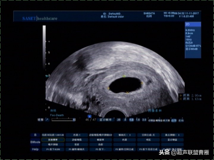 3毫米卵黄囊未见胎芽正常么,40多天的卵黄囊