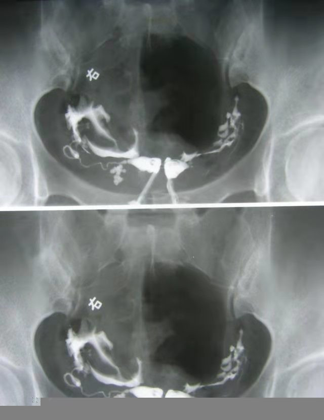 女子被查出有双子宫,24岁女子体检发现有两个子宫
