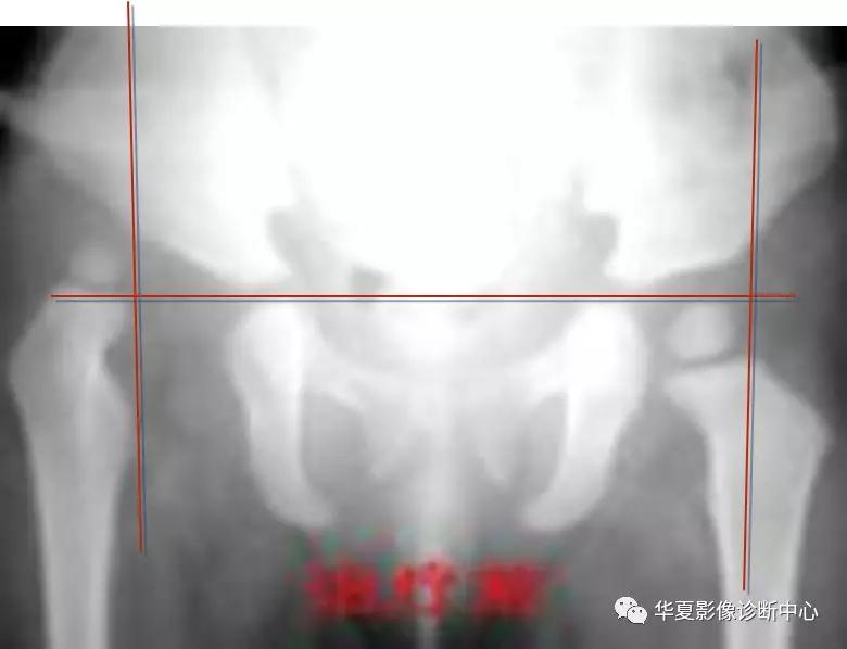 先天性髋关节脱位,先天性髋关节脱位属不属于残疾人