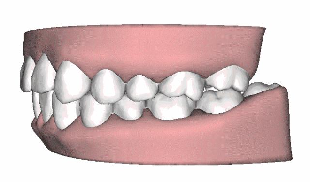 戴牙套2年不戴保持器反弹案例,戴牙套成功案例不戴保持器