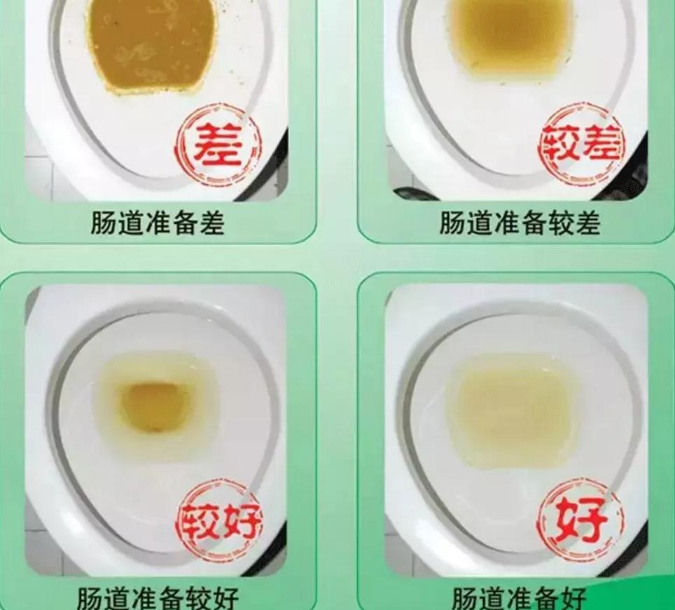 肠镜肠道准备必须喝3升泻药吗,无痛肠镜肠道准备差会影响结果吗