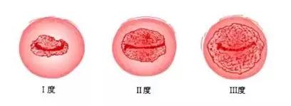 宫颈糜烂二度宫颈肥大宫颈囊肿,宫颈糜烂肥大囊肿会引起宫颈癌吗