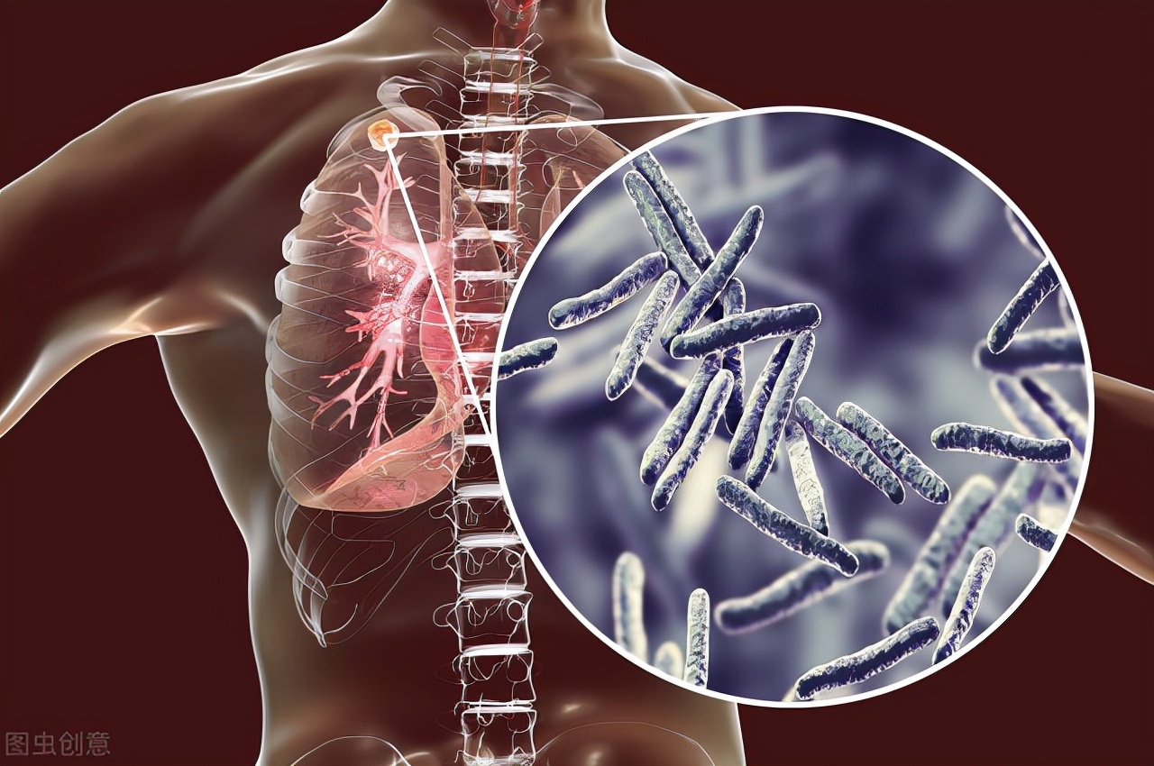 中医治疗肺炎肺结节,肺结节误诊为肺癌几率多少