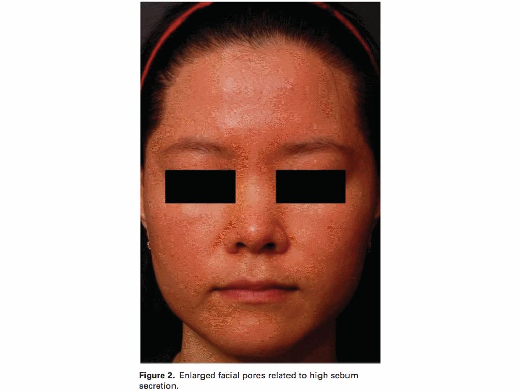 脸上毛孔粗大怎么改善别慌还有救,痘坑毛孔粗大治疗的科普视频