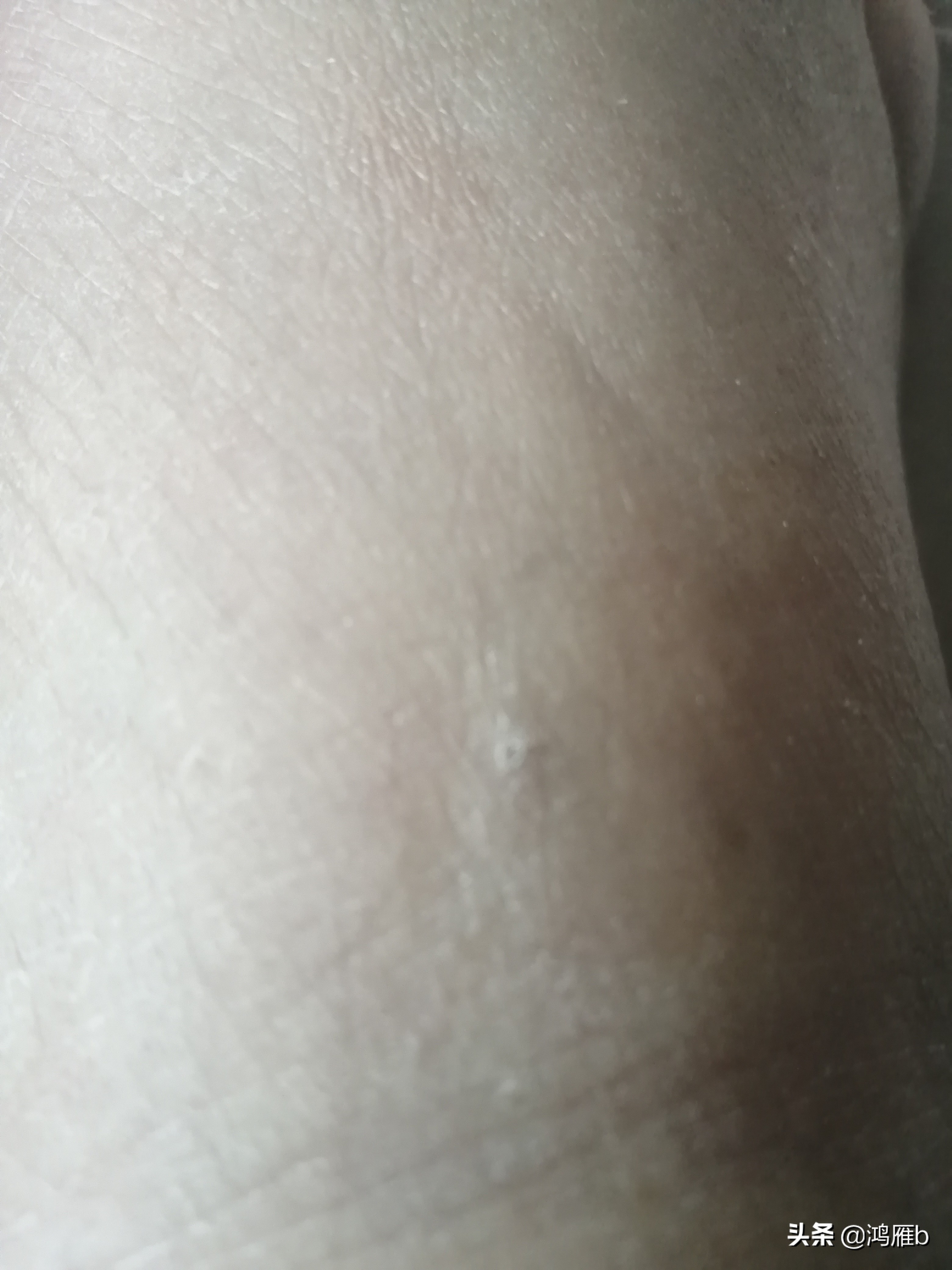 回忆七十年代的碱厂一0五医院，记得我当年两元钱做的手术