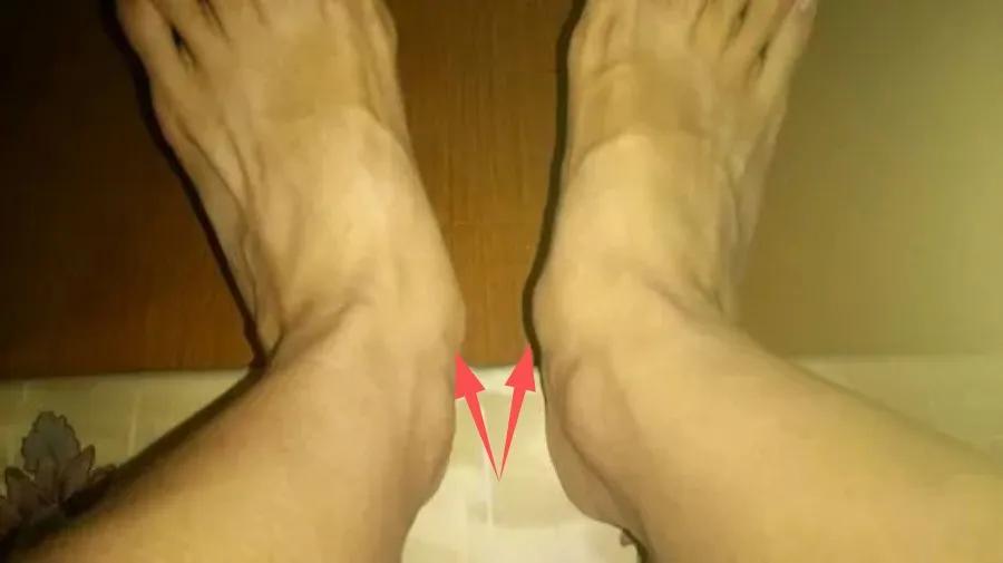 脚上多长了块骨头,腿关节多长了一块骨头