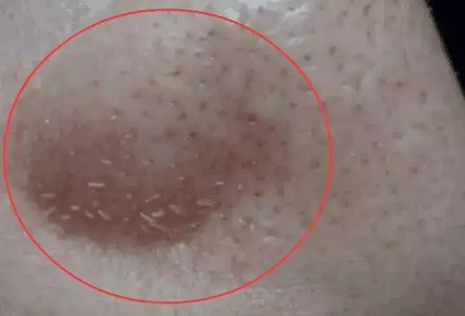 为了祛痘，小伙买10条活蚂蟥放脸上！结果悲剧了……