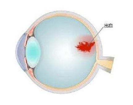 眼底出血是怎么引起的？如何预防？