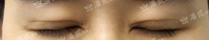 全切双眼皮提肌失败还能修复吗,什么是失败的双眼皮